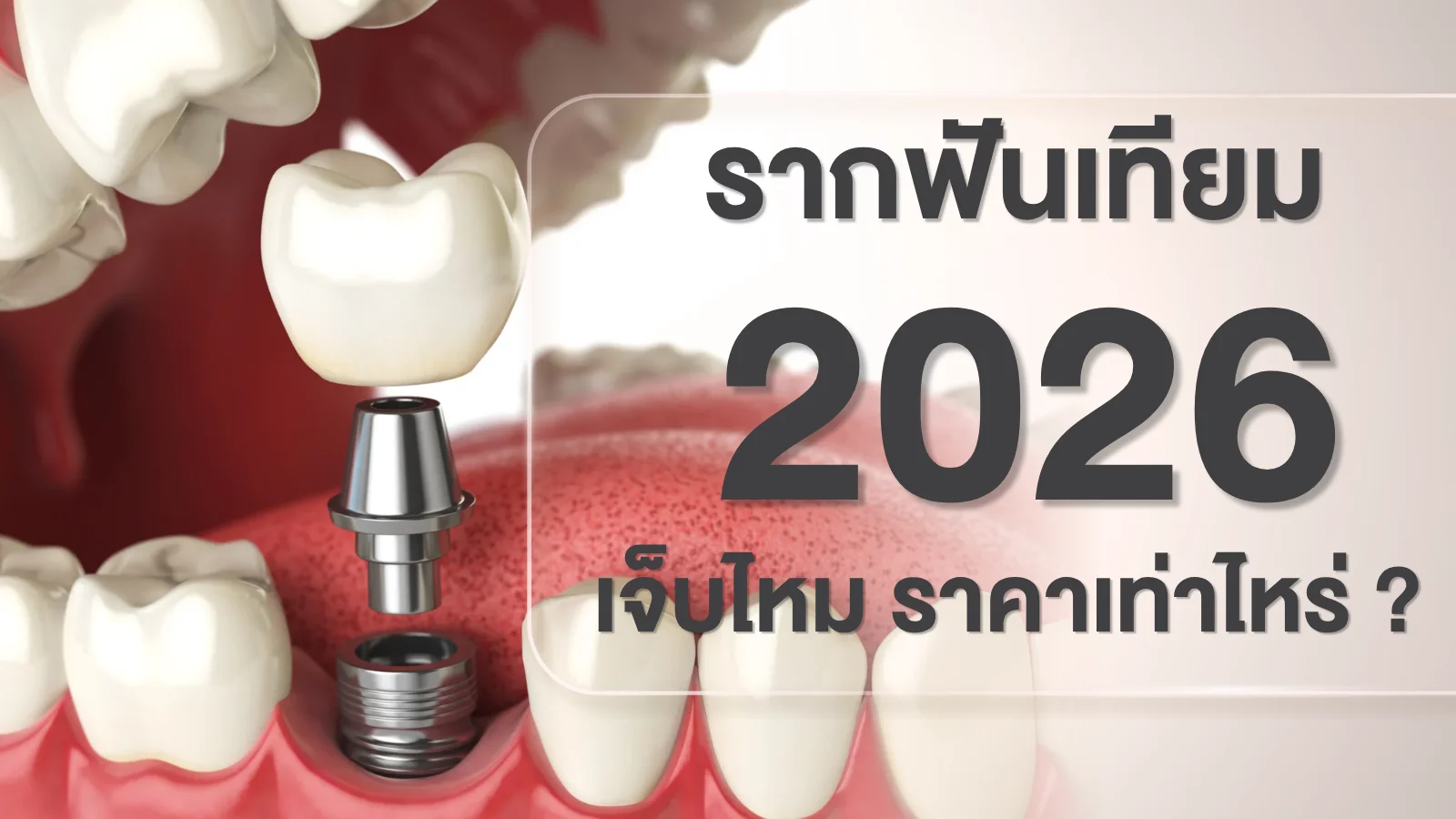 รากฟันเทียม Dental Implant