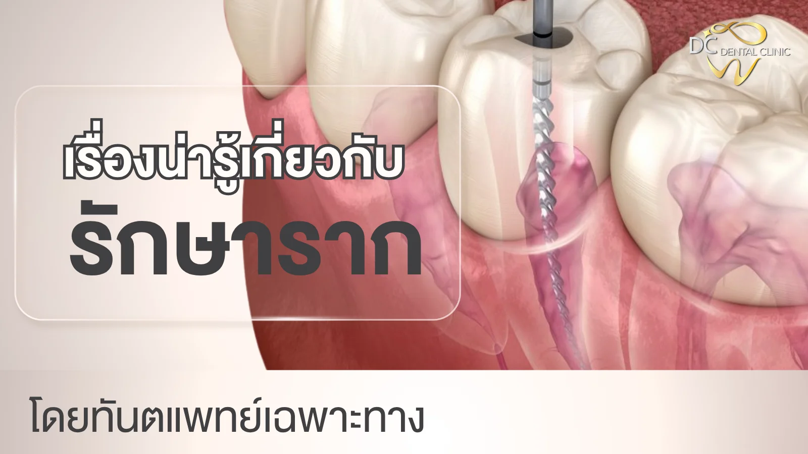 ขั้นตอนรักษารากฟัน