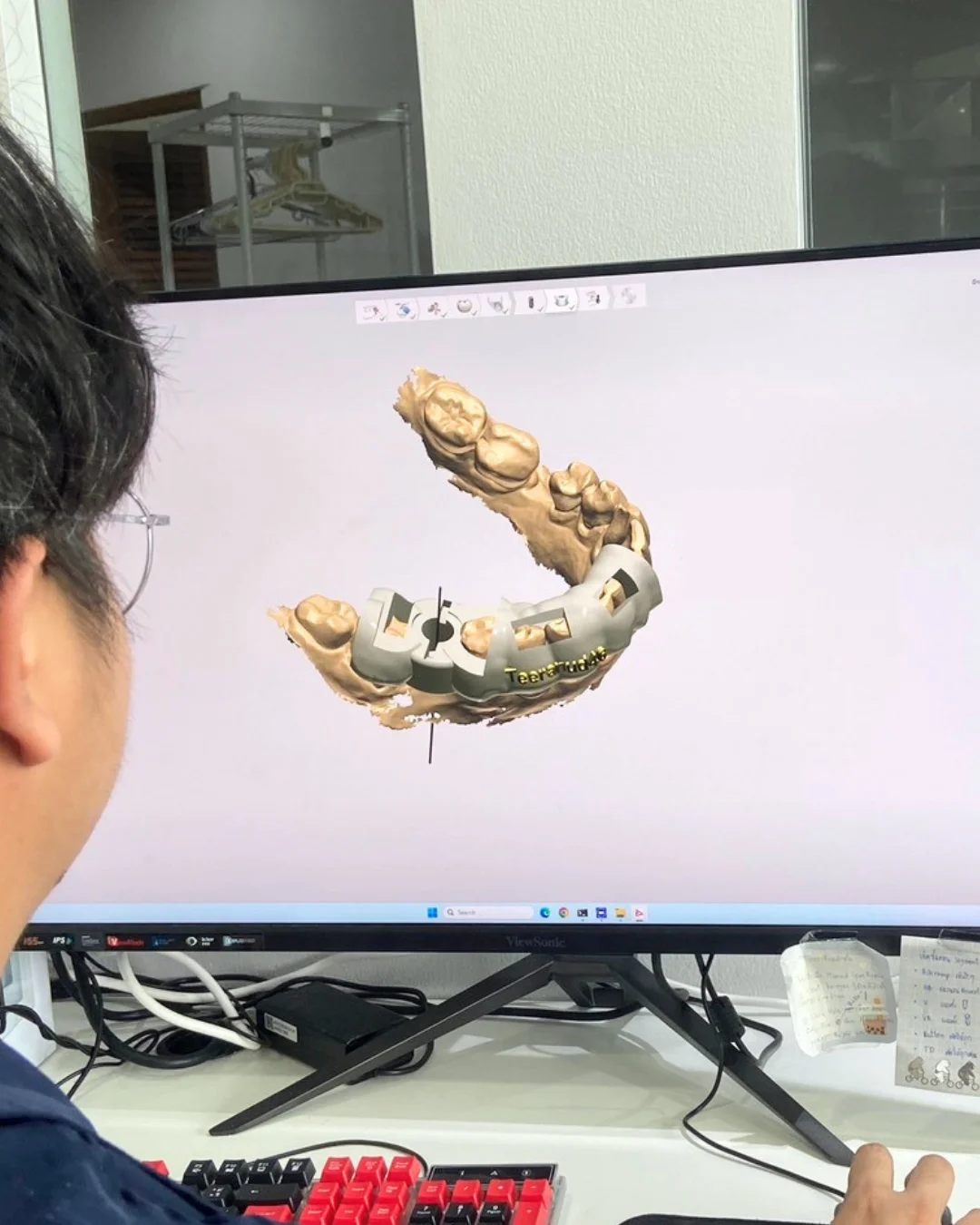 วางแผนตำแหน่งรากฟันเทียมบนภาพสามมิติ