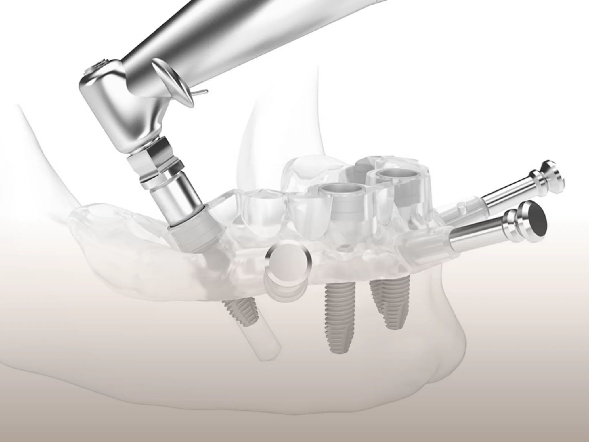 ขั้นตอนการฝังรากฟันเทียมด้วย Digital Stent