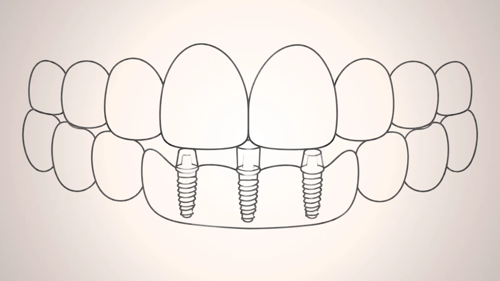 ภาพกราฟครอบฟันบนรากเทียมหลายซี่