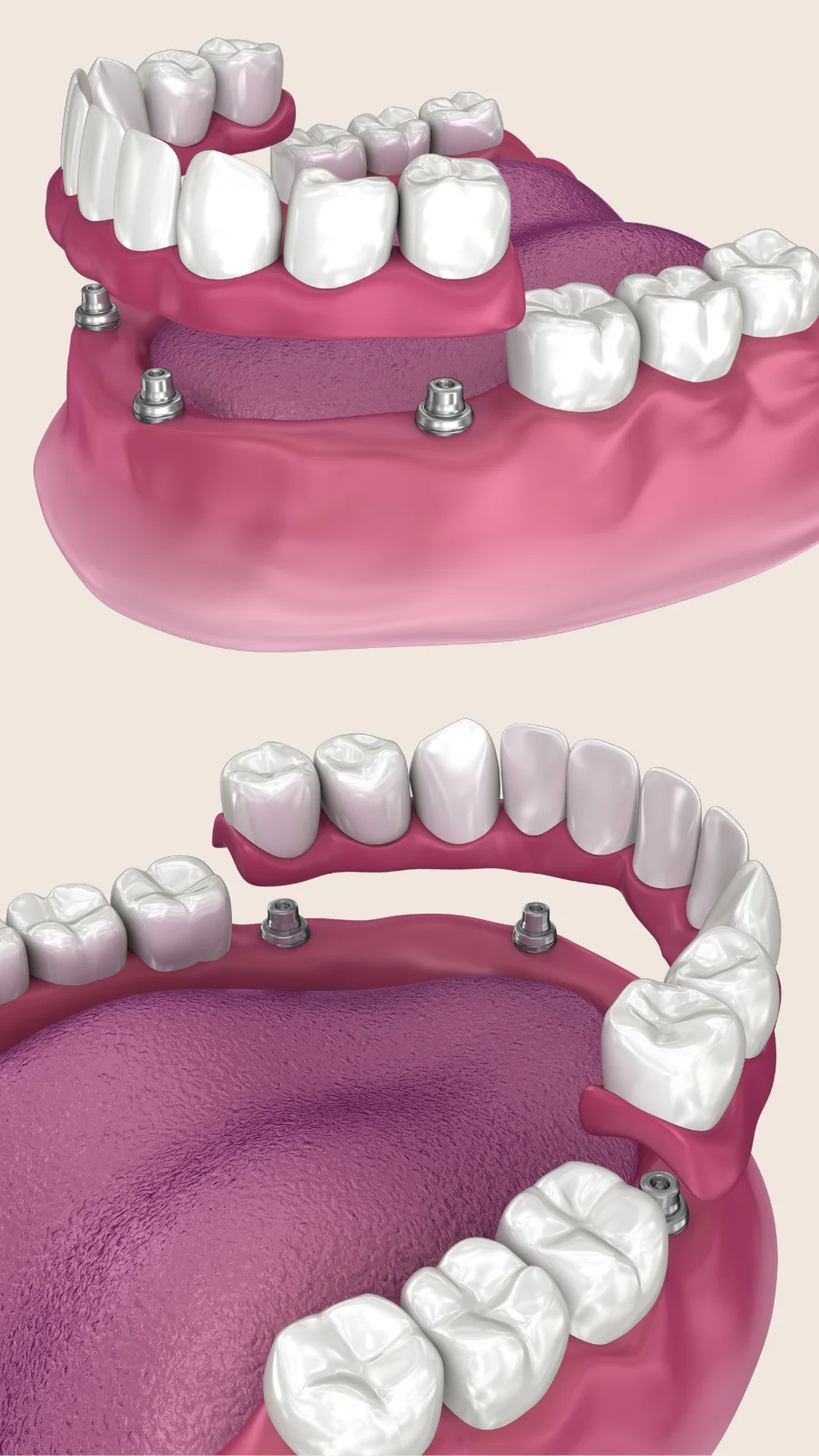ฟันปลอมยึดกับรากฟันเทียม (Implant Overdenture)